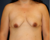 Feel Beautiful - Breast Augmentation-Lift 51 - Before Photo